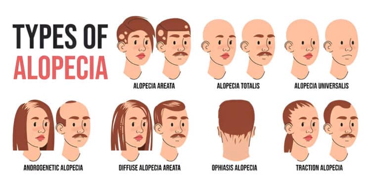 Medical-Wigs-for-Alopecia-and-Hair-Loss