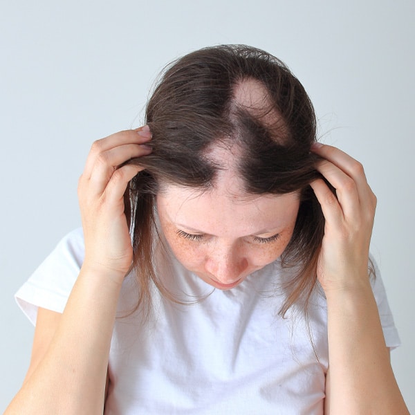 Alopecia Wig
